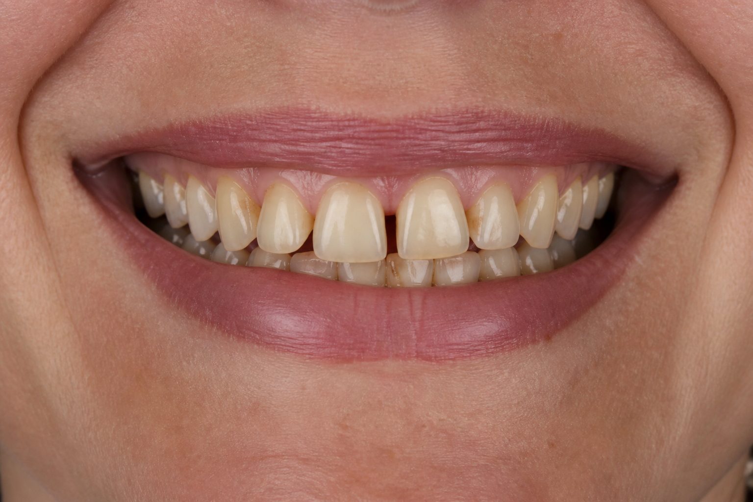 Örnek veneer vakası — önce